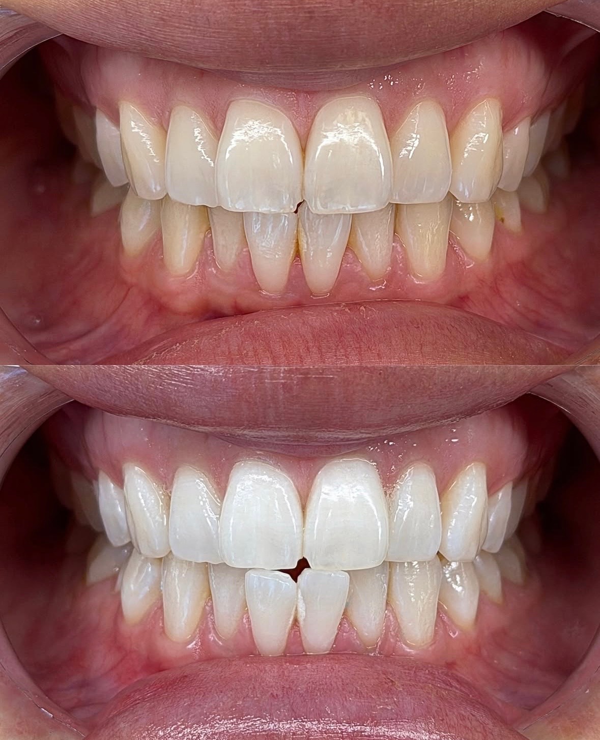 Before and after teeth whitening result 3
