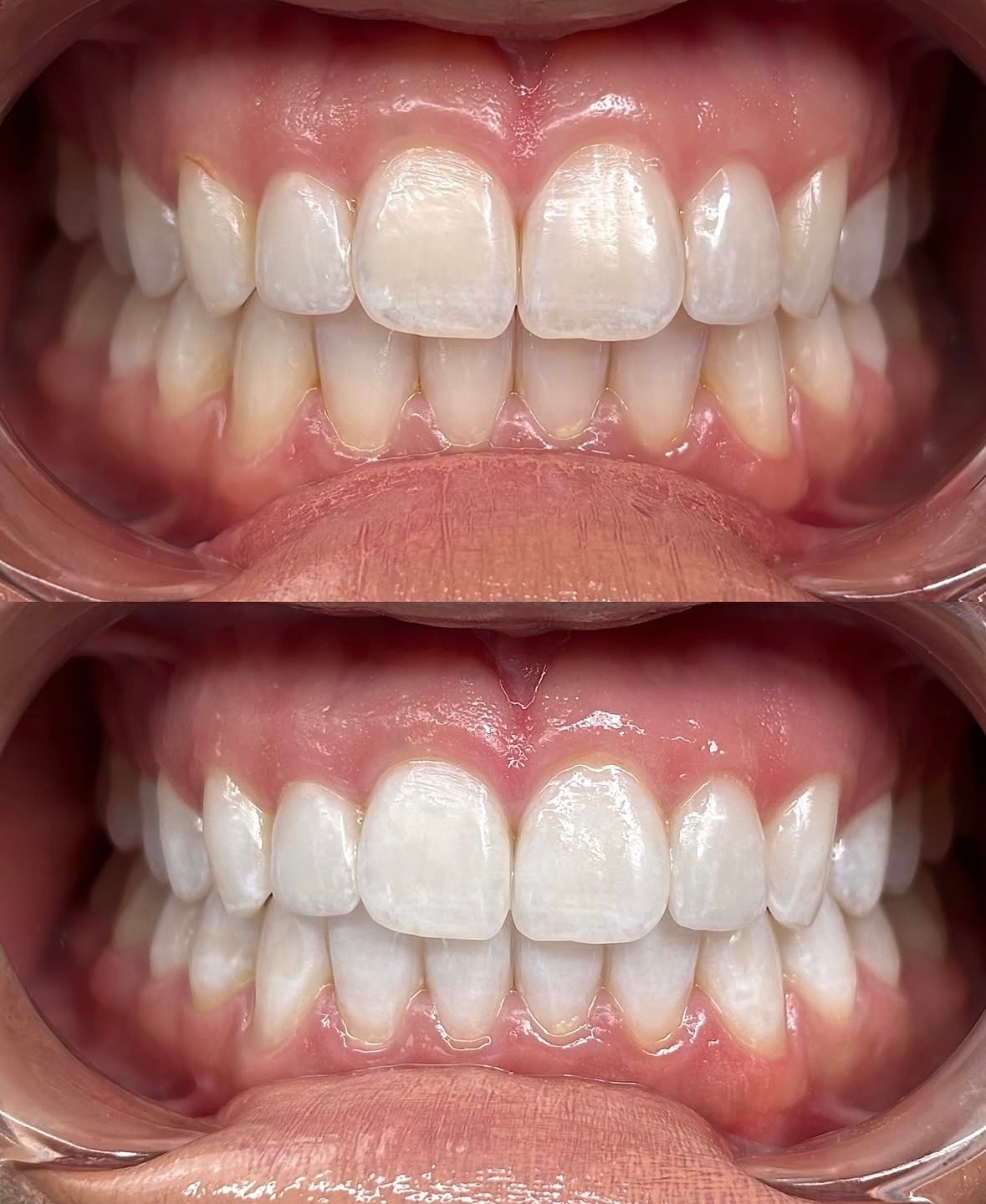 Before and after teeth whitening result 2